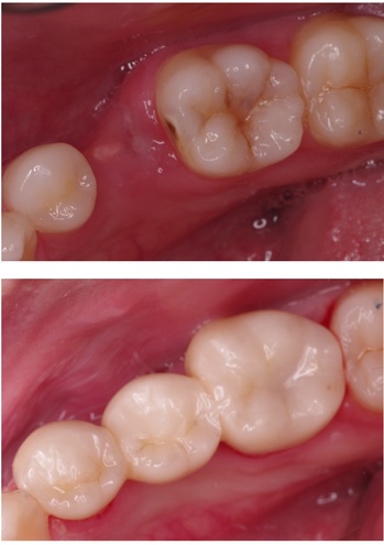 niigata_ whitening_zirconia.jpg